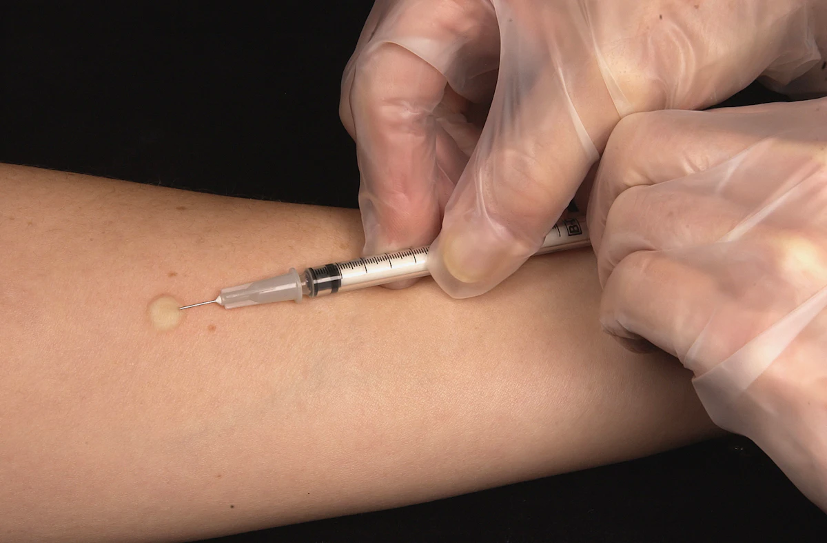 Clinician placing a TB skin test on a forearm